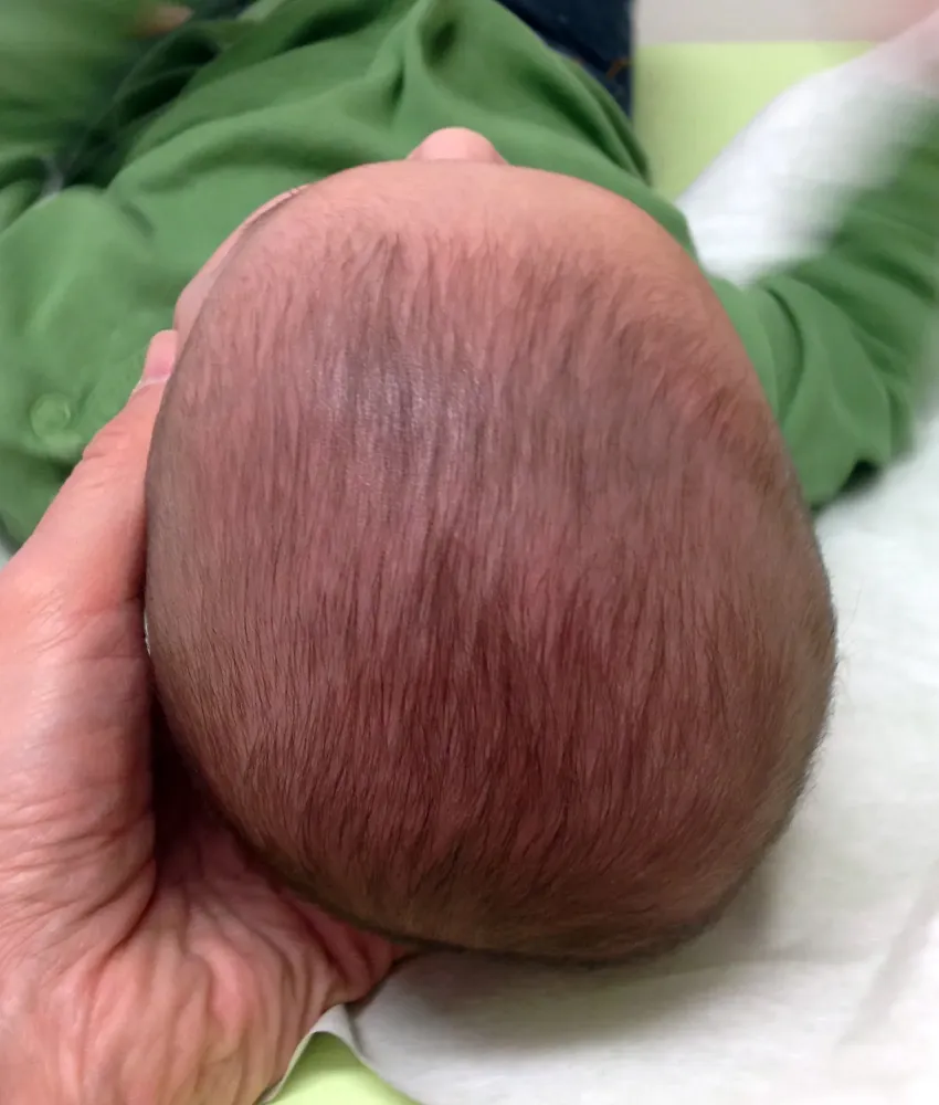 Plagiocéphalie à Saint-Vivien