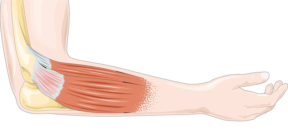 Tendinite à Saint-Vivien